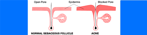 acne proactive n2 treatment